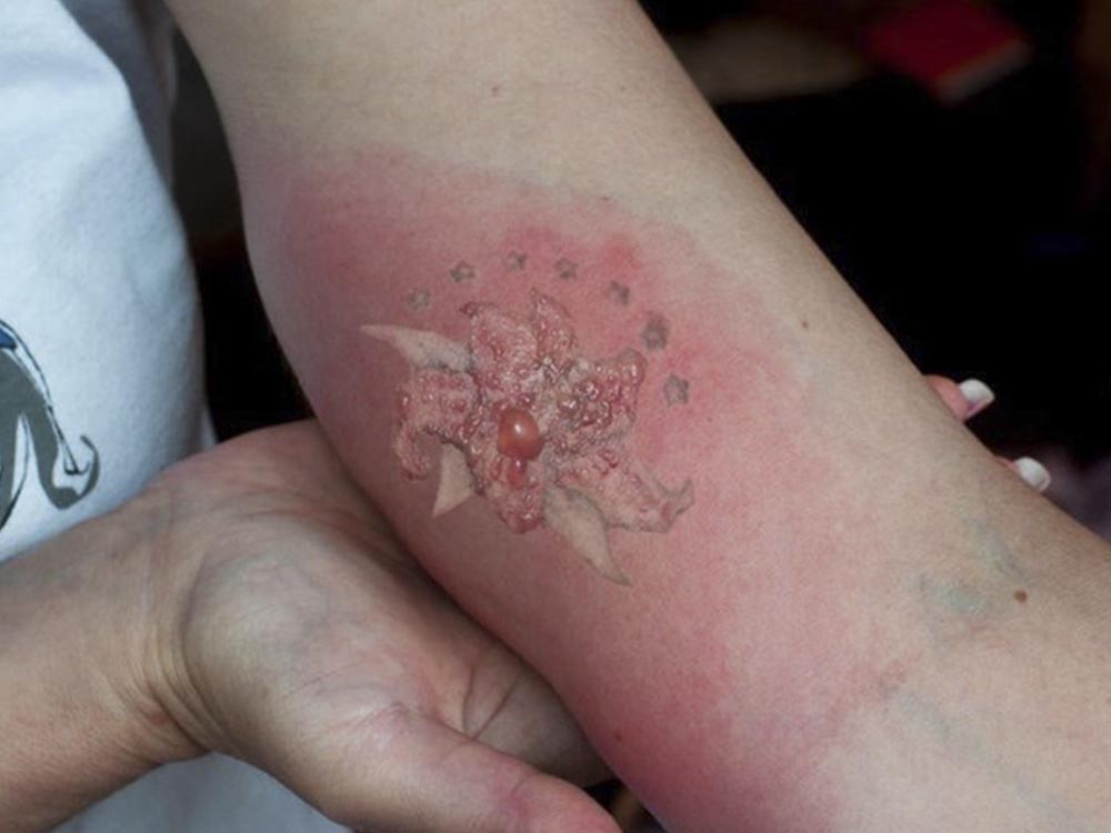 tatuaj infectat